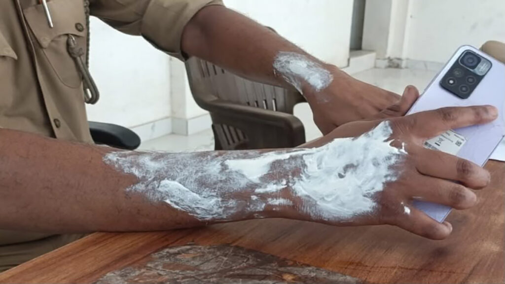 पत्नी से विवाद के बाद थाने के बाहर आत्मदाह का प्रयास, बचाने में 3 पुलिसकर्मी भी झुलसे