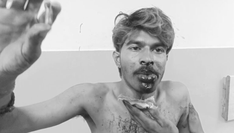 फ्लैग मार्च के बीच कदमा में चली ताबड़तोड़ गोली, युवक के जबड़े को चीर निकली गोली
